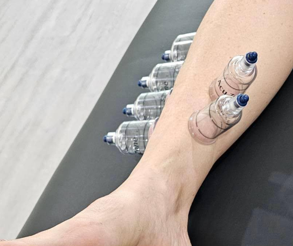 Cupping