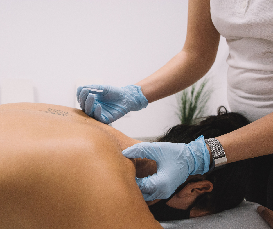 Dry Needling
